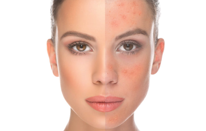 acne cure organic